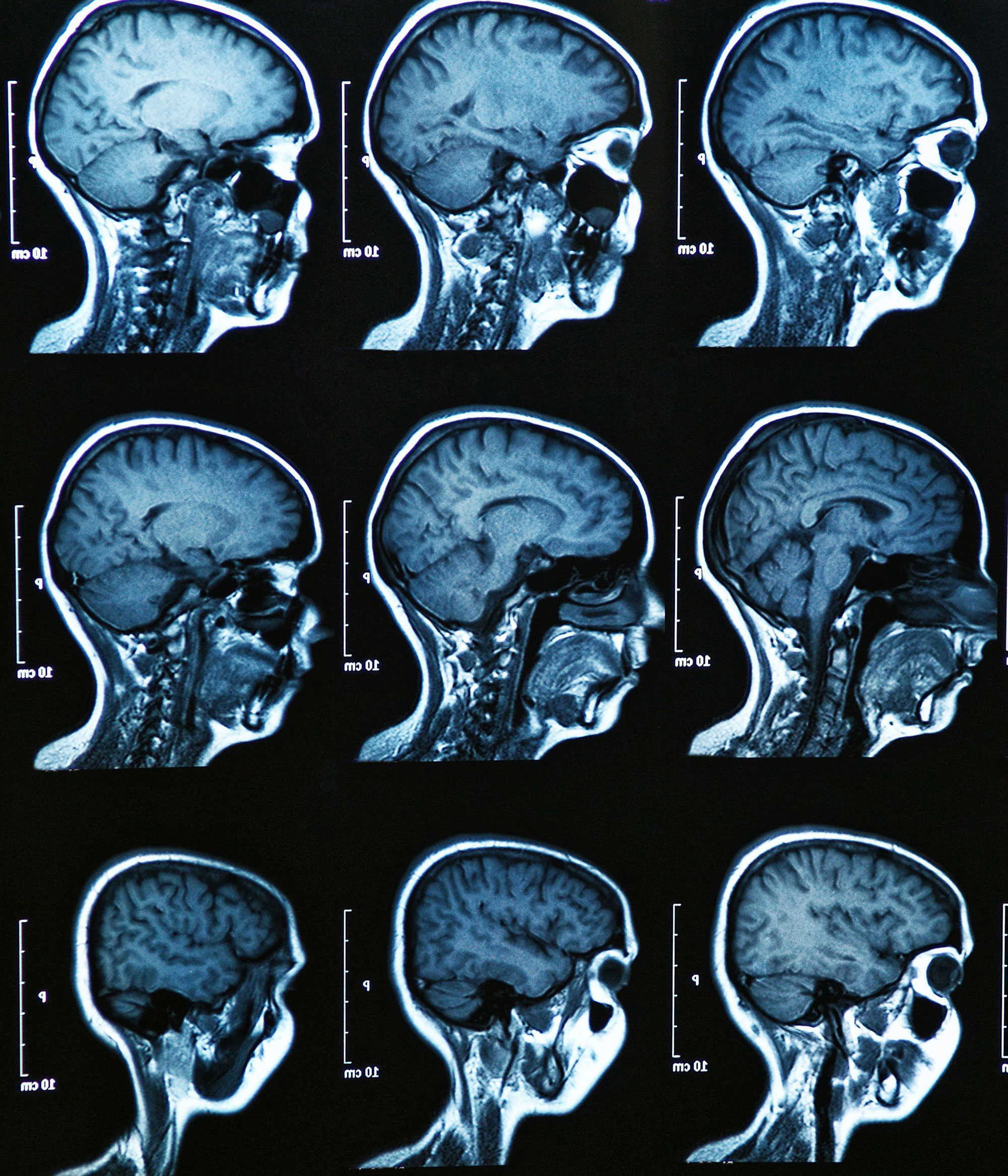 MRI Brain Scan